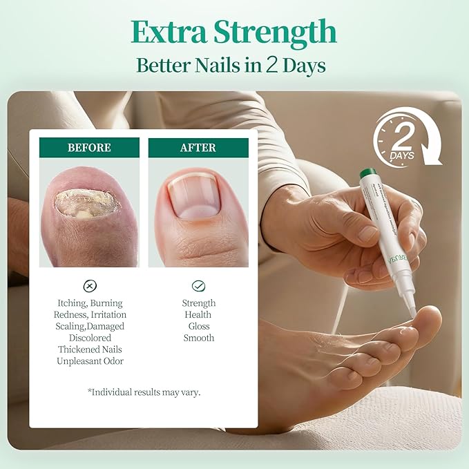 Apuree Antifungal Pen Extra Strength: 25% Undecylenic Acid 1% Tolnaftate | 6Pcs Day & Night Care Nail Fungus Pen | FSA-HSA | Fungal Nail Treatment Repair For Damaged Yellow Discolored Thick Nails