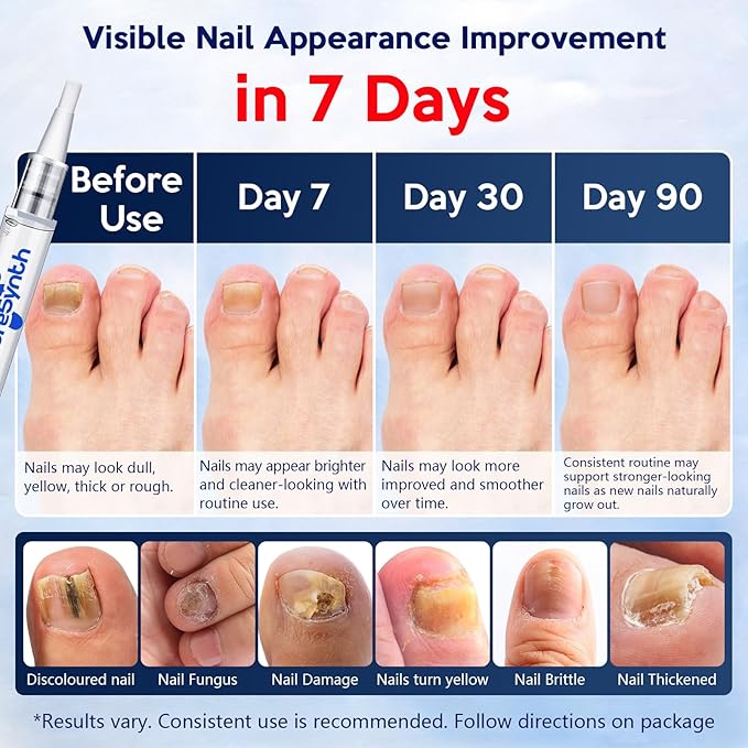 Extra Strength Nail Fungus Repair Pen (OTC Maximum Strength), 25% Undecylenic Acid + Aloe & Vitamin E, For Thick Yellow Discolored Nails,24 mL (0.81 fl oz) Total, 8-Pack,Designed in USA