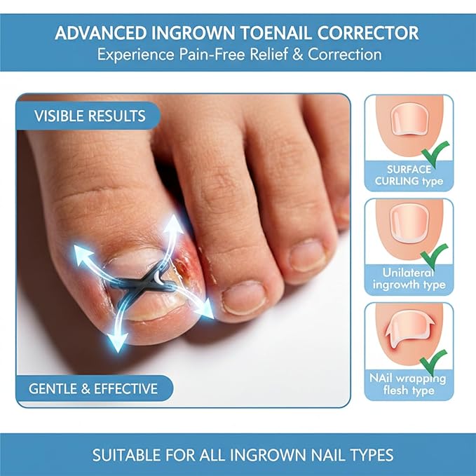 Ingrown Toenail Treatment Corrector Strips, Titanium Alloy Ingrown Nail Curve Corrector, Ingrown Toenail Tools for Home Use, 6Pcs