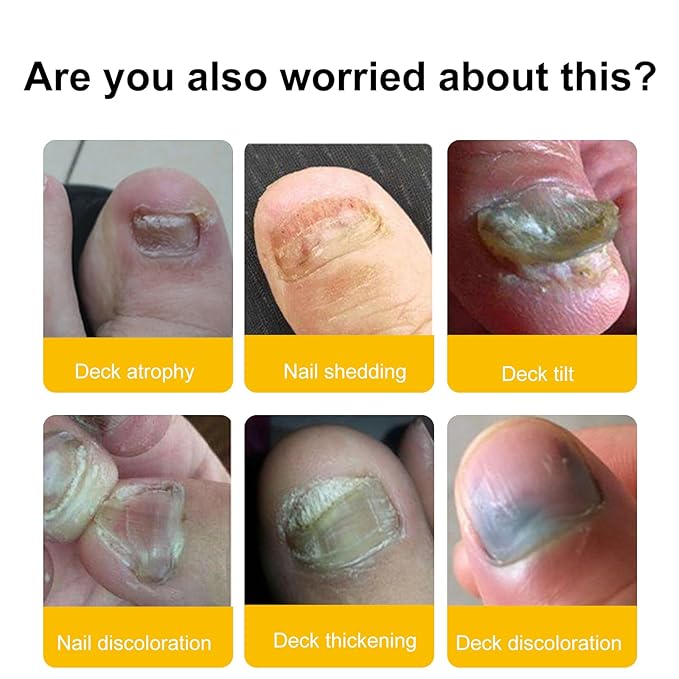 Multi-Purpose Nail Repair with Tolnaftate - Toenail Fungus Treatment Extra Strength Antifungal Solution - Restores Discolored and Damaged Nails - Gentle Formula for Adults & Seniors - 1 fl oz