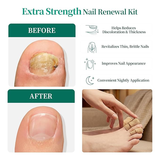 APUREE Fungal Nail Patches Extra Strength: True 1% Tolnaftate | 8H Overnight Toe Nail Fungus Treatments |Repair For Discolored Yellow Brittle Damage Nails| Restores Healthy Appearance| 32 Patch