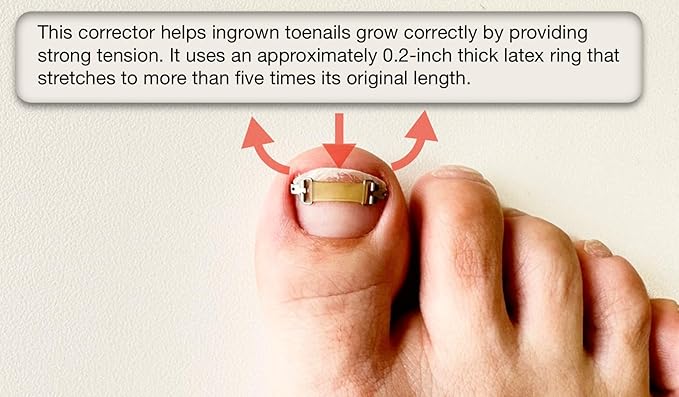 Ingrown Toenail Treatment & Corrector with Latex Elasticity - Curved Toenail Straightener | Effective Daily Solution for Ingrown Toenail Pain & Growth Correction [XL/0.87inches/21-23mm]