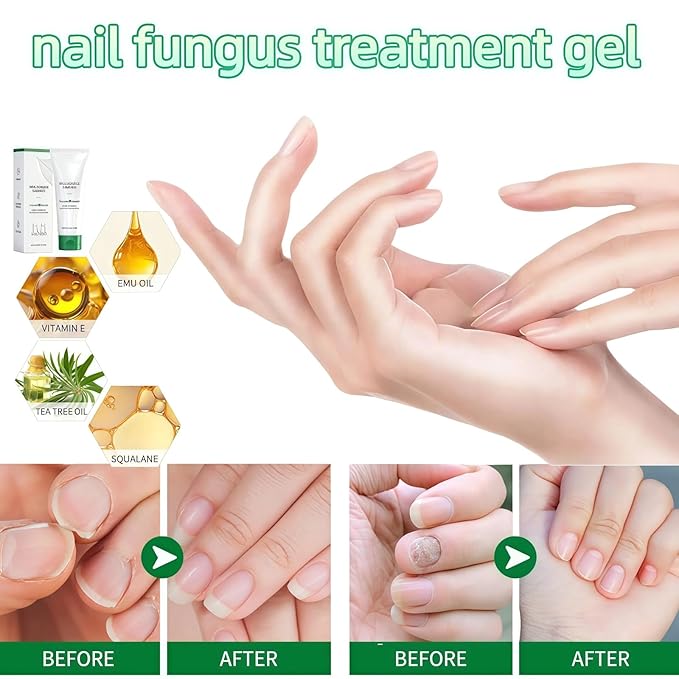 2PCS Nail Repair Gel. Toe Nail Fungus Treatments Multi Purpose Nail Repair Oil Essence