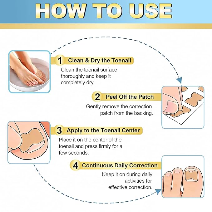 Ingrown toenail treatment，Breathable toenail correction patch, 50-piece package, can quickly repair toenails, using high-viscosity-grade glue, not easy to fall off, and easily solve toenail problems.