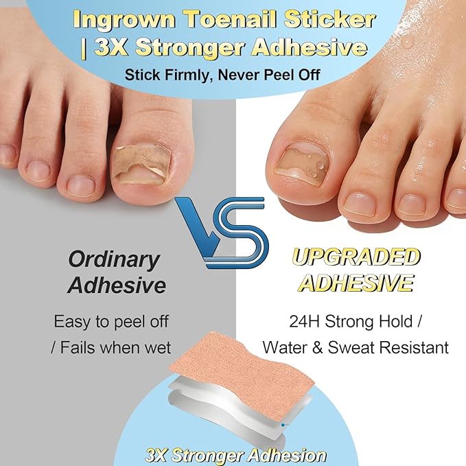 Ingrown toenail treatment，Breathable toenail correction patch, 50-piece package, can quickly repair toenails, using high-viscosity-grade glue, not easy to fall off, and easily solve toenail problems.