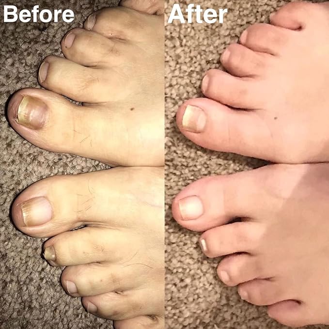 Probelle Natural Renewal Nail Oil, Nail Color Restoration, Clear Topical Solution, Restores Appearance of Discolored or Damaged Nails, .5 oz/ 15 ml