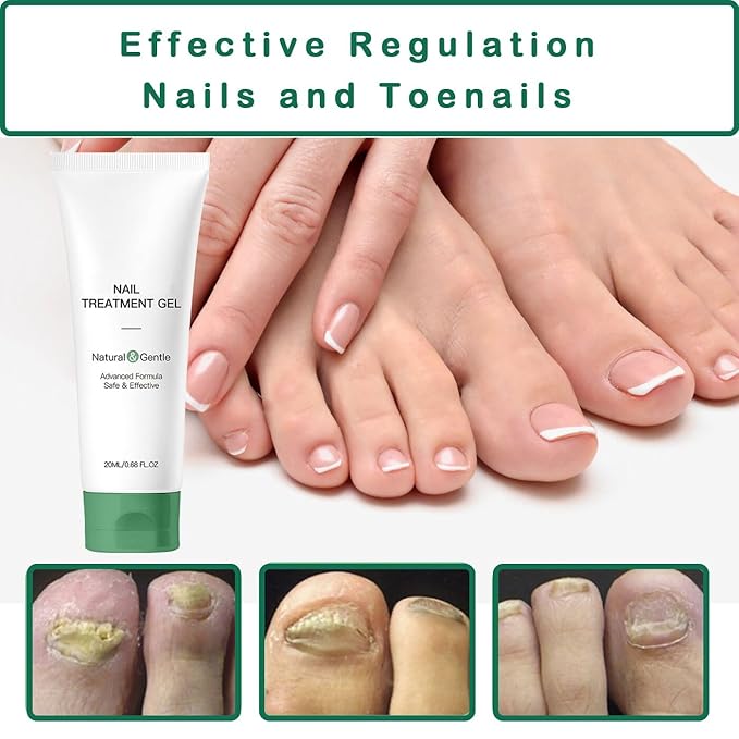 Nail Treatment Gel - 2 PCS Nail Growth Repair Cream for Fingernails and Toenails, Fix & Renew Damage Fungal Nail, Broken, Cracked & Discolored Nails