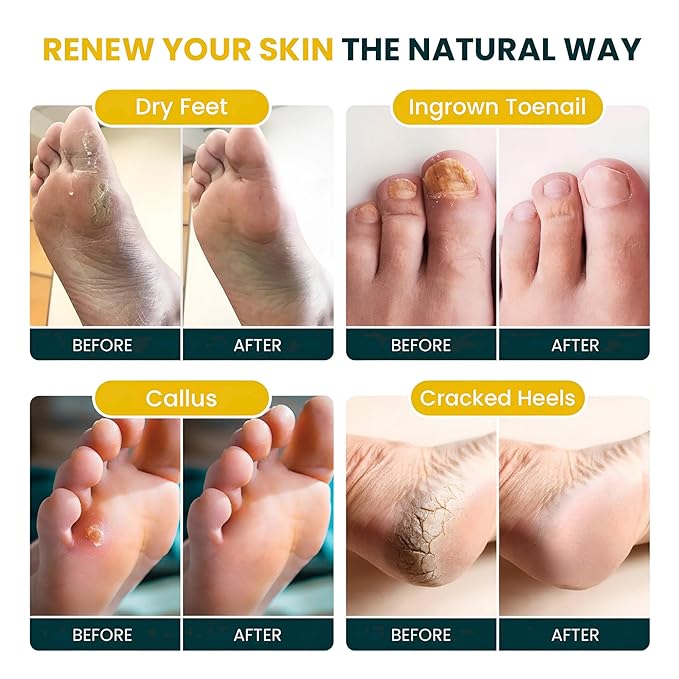 FOOT CURE Tea Tree & Citrus Foot Soak with Epsom Salt – Supports Tired Feet, Softens Calluses, and Refreshes (Pack of 2)
