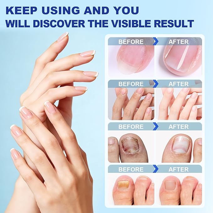 Nail Patches for Toenails- 2Pack, Toenail Stickers Feet, 8-Hour Overnight Nail Patches Fits Large and Small Nails, 42 Count (Blue A)
