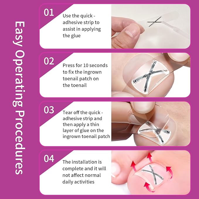 10 Patchs X-Shaped Upgrade Titanium Alloy Ingrown Toenail Corrector,At Home Ingrown Toenail Treatment for Man and Women,Ingrown Toenail Removal Kit,Curved Toenail Straightener (Small Size)