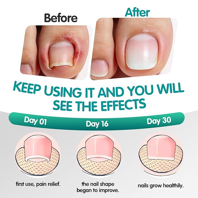Ingrown Toenail Treatment, 60 Pcs Breathable Ingrown Toenail Strips, Painless Toenail Support Tool for At-Home Pedicure and Foot Care, Toenail Corrector Patch （60 Count (Pack of 1)）