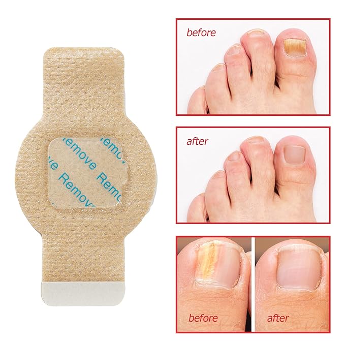 Fungal Nail Patches -Toenail Treatment Extra Strength 21Pcs- Nail Repair for Restores Damaged Nails and Appearance of Discolored
