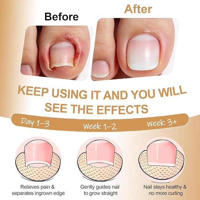 Ingrown Toenail Removal & Corrector Kit for Fast Pain Relief - Professional Ingrown Toenail Treatment Kit with Curved Strips, Breathable Patches & Pedicure Tools, Prevention & Healthy Nail Growth