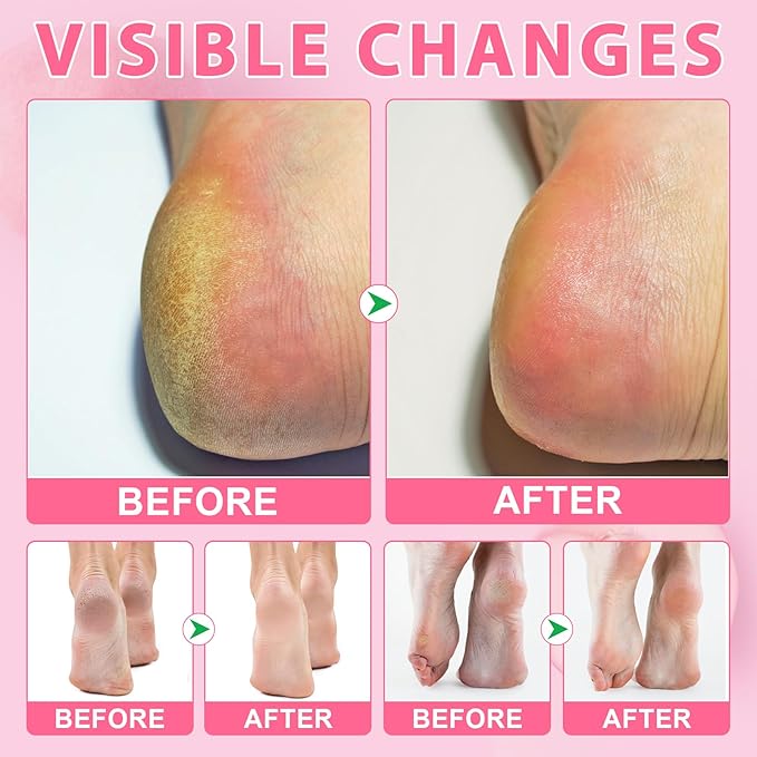 2 Pack Urea Cream 60% Plus Salicylic Acid 2% Foot Balm Stick for Dry Cracked/Chapped Heel, Skinned knees, Hand Intensively Hydration/Moisturization, Callus Removal/Softening/Soothing-Peach Scent|40g