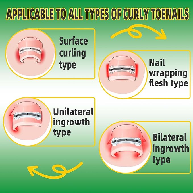 Ingrown Toenail Treatment Kit, Titanium Alloy Ingrown Toenail Removal Kit, Nails Corrector Tool & Remover Strips - Ingrown Toe Nail Quick Relief