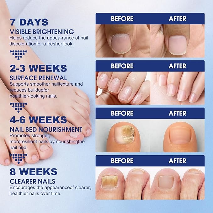 Toenail Fungus Treatment Extra Strength - 42 Pcs Fungal Nail Patches, nail repair patches-8-Hour Firm Adhesion, Nail Repair patches for Damaged Nails, Overnight Renewal for Men and Women