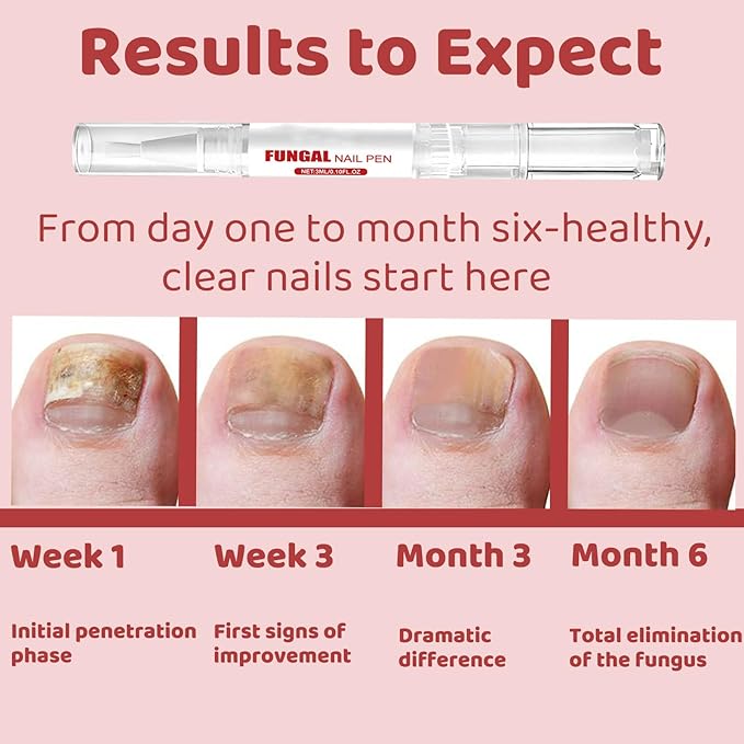 Fungal Nail Pen with Allicin & Undecylenic Acid, Extra Strength Nail Repair for Yellow, Discolored, Thick or Damaged Nails, Toenail & Fingernail Care (2PCS)