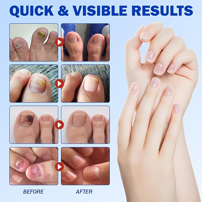 Toenail Treatment Extra Strength, 8-Hour Nail Patch for Strengthening, Strengthens Brittle Nails, 21pcs Nighttime Nail Repair for Damaged, Discolored Nails