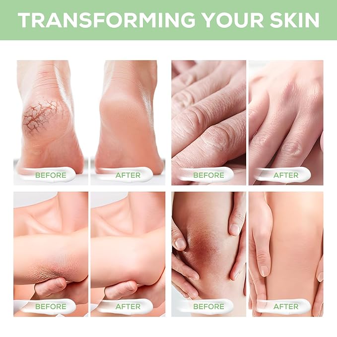 Urea Cream 40 Percent for Feet, plus 2 Percent Salicylic Acid - for Rough Thick Dry & Cracked Skin - Gently Exfoliates - Feet Hands Elbows - Tea Tree, Aloe Vera - 5.29 Oz(150g)