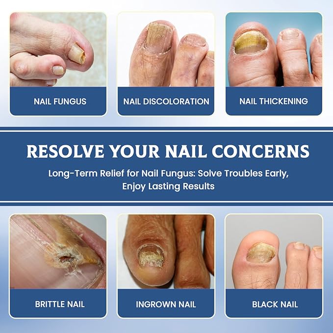 32 Pcs Fungal Nail Patches,Toenail Fungus Treatment Extra Strength - Toe Nail Fungus Treatments for Men and Women, Overnight Renewal Nail Repair Patches