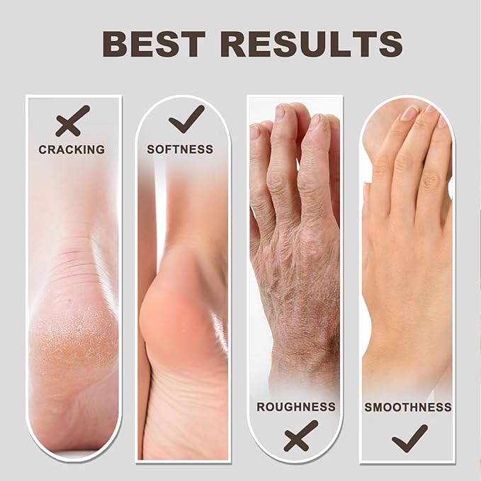60% Urea Foot & Hand Cream with 2% Salicylic Acid - Intensive Moisturizer for Dry, Cracked Heels, Feet, Elbows, Hands and Knees - Foot Exfoliating Creams with Jojoba Oil, Avocado Oil & Aloe Vera, 7 oz