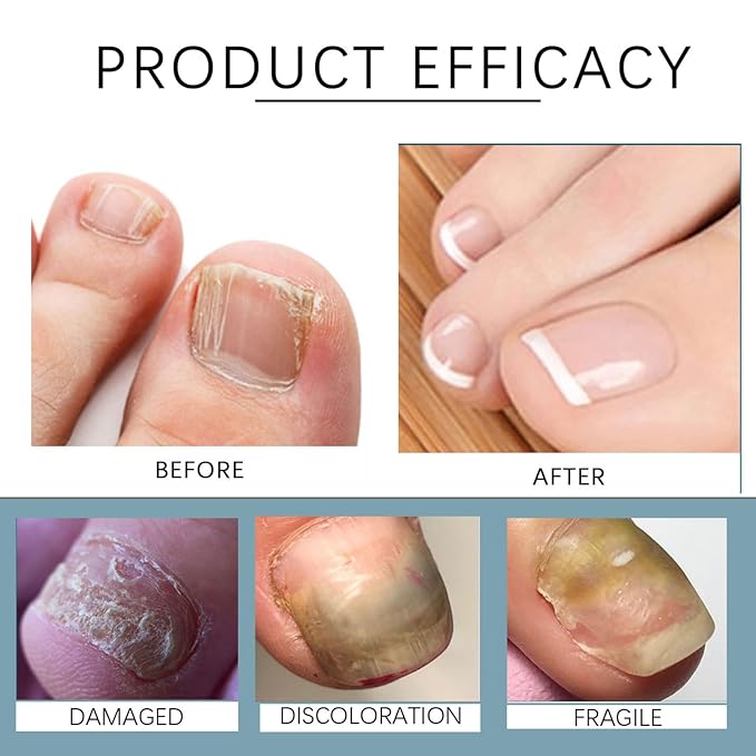 2PCS 3 Days Nail Care, Keratin Amino Acid Formula Nail Treatment Oil, Clear Nail Treatment Oil, for Dry Weak Fragile Nails