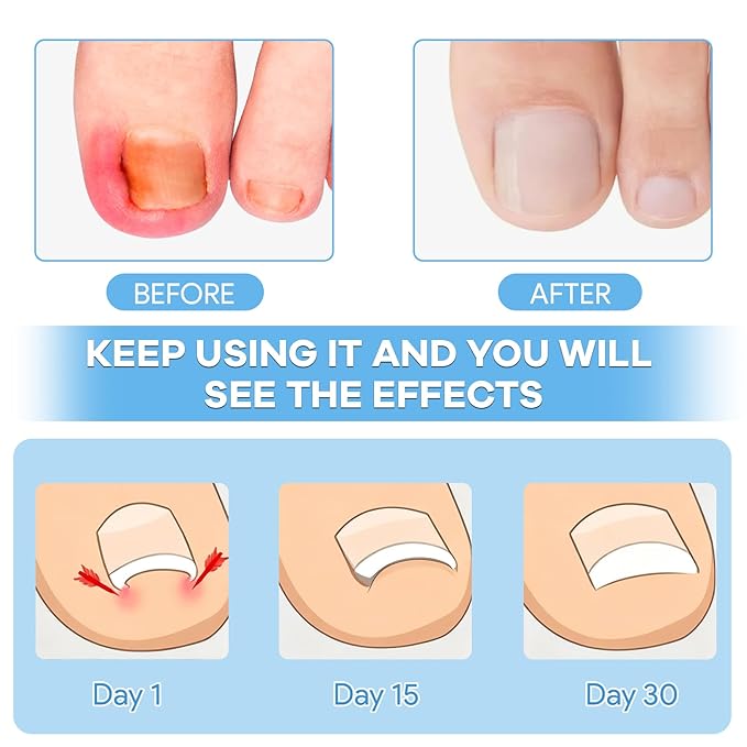 Ingrown Toenail Removal Kit with Ingrown Toenail Strips, Curved Toenails Corrector Patch, Nail File and Lifter Pedicure Tools for Women Man