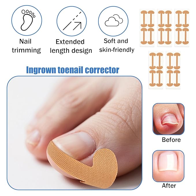 Professional Ingrown Toenail Removal Kit, Including Ingrown Toenail C-Shaped Patch Tools, Wide Nail Corrector Sticker, Correction Sticker Strips & Toe Separator, etc for Home Pedicure