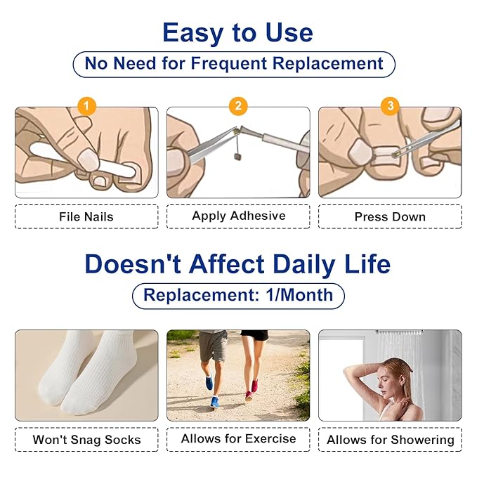 Nitinol Ingrown Toenail Corrector,at Home Ingrown Toenail Treatment,Curved Toenail Straightener,Ingrown Toe Nail Relief，Ingrown Toenail Removal Kit (11/16 In,13/16 In)