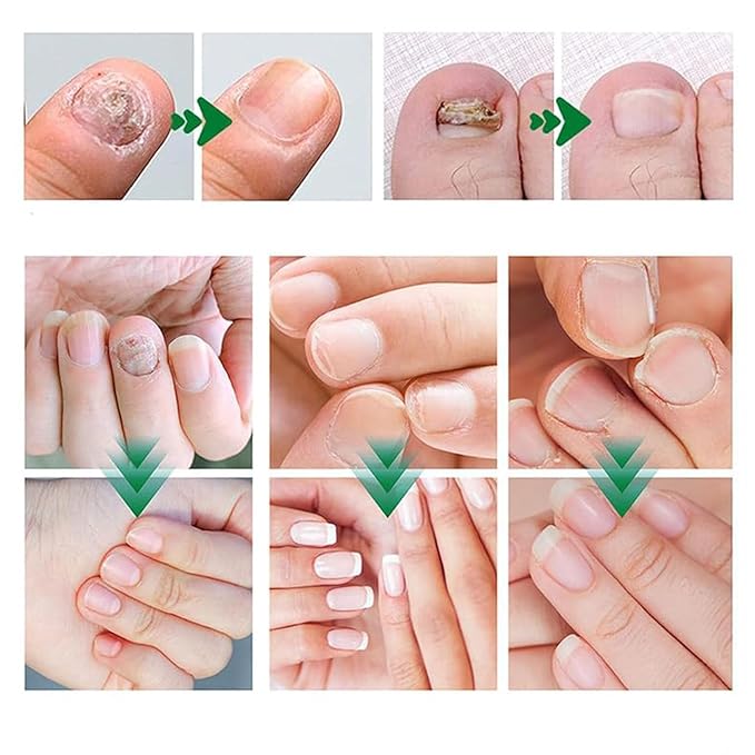 Nail Fungus Treatment Gel, Natural Nail Repair Care Gel, Nail Oil for Growth & Strength, Nail Growth Serum, Strengthening Cuticle Serum - 2pcs