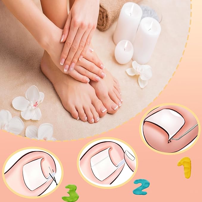 Ingrown Toenail Corrector Kit with Flexible Correction Strips & Tape – Professional Home Pedicure Tool Set for Painless Ingrown Nail Treatment, Toenail Brace & At-Home Care