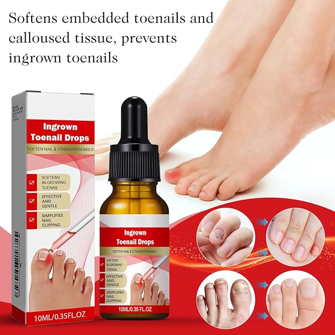 2PCS Ingrown toenail drops,Ingrown Toenail Relief,Easy Trim Ingrown Toenail Tools,Toenail Fluid With Silicone Gel Toe Caps Essential Oil Diffuser,Ingrown Toenail Reliever and Softener Kit