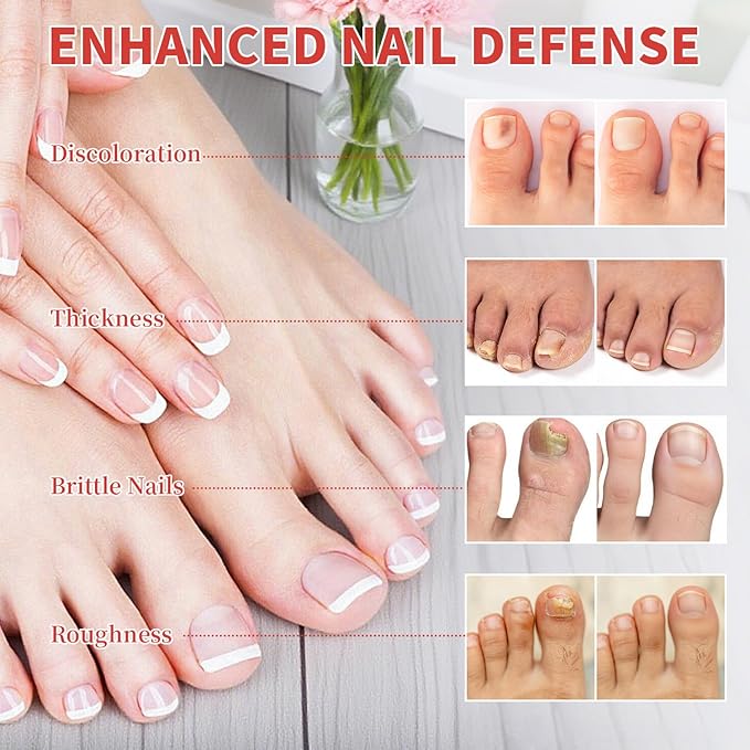 Toenail Fungus Treatment Extra Strength – 30 Pcs Fungal Nail Patches, Nail Fungus Patches for Toe Nail, Helps Improve Damaged & Discolored Nails, Overnight Renewal for Men and Women (strip)