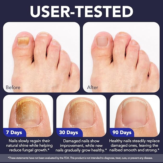 Toenail Fungus Pen - Toenail Fungus Treatment Extra Strength for Damaged, Discolored Nail - 25% Undecylenic Acid with Tea Tree, Jojoba, Clove Bud Oils & Aloe - Fungal Nail Repair Pen 5 Pack