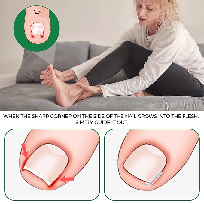Ingrown Toenail Kit - Ingrown Toenail Drops, Ingrown Toenail Set - 60 Pcs Toenail Straightener Strips -Toenail Lifter Small Scissors