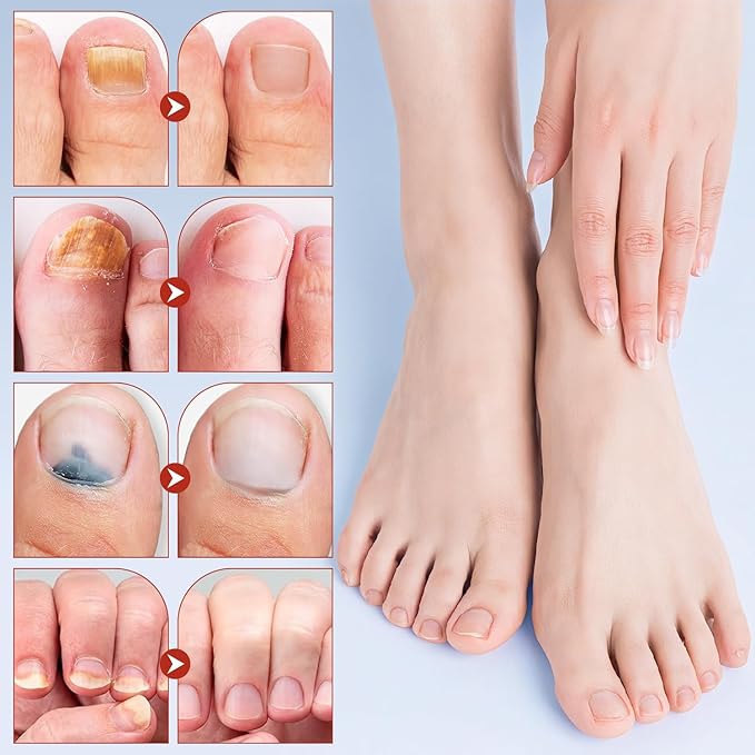 Nail Patches, 8-Hour Overnight Treatment, Fast-Acting Toenail Repair Patches, 21 Patch,for Damaged Nails Foot Nails Repair and Care,Strengthens Brittle Nail (21 Patch*2)