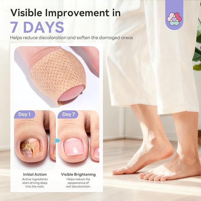 SAVILAND Extra Strength Fungal Nail Patches: 96 Patch 8H Overnight Repair 1% Tolnaftate Toenail Treatment Nighttime Nail Renewal Restores Damaged Nails Discolored Thick Yellow Healthy Appearance