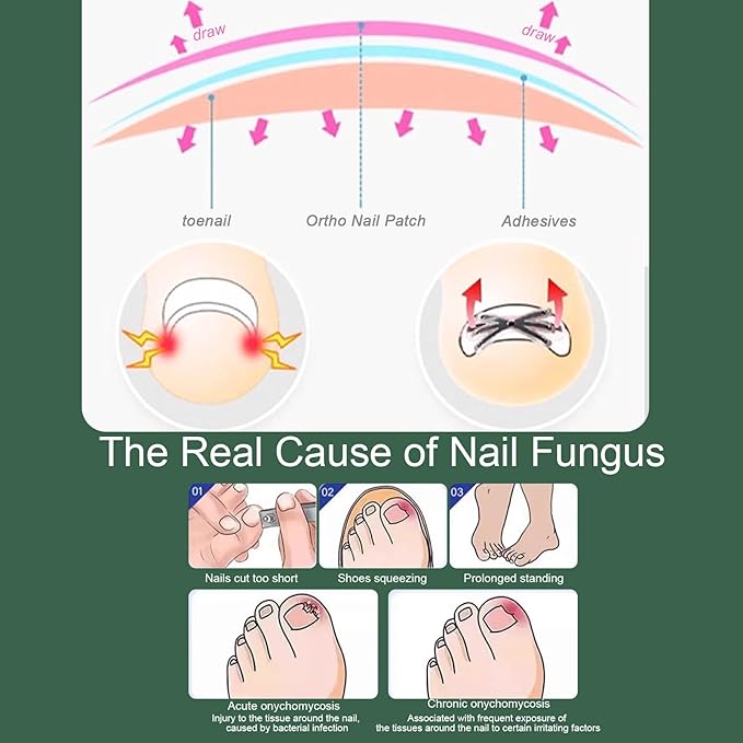 Titanium Alloy Ingrown Toenail Corrector Kit, Toenail Brace Tools for Curved and Ingrown Nails, Self-Adhesive Nail Correction Strips, 2 Sizes (0.63 & 0.67 in)