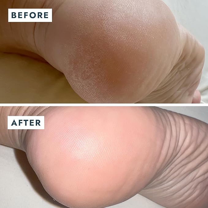 VOESH Solemate Heel Repair Balm, Heel Moisturizer & Repair, Balm for Rough and Cracked Heels, Foot Care
