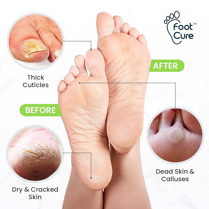 Toenail Fungus Treatment Extra Strength - for fingernails, nail repair, toenail softener, yellow toenail treatment, ingrown nail and foot fungus treatment extra strength