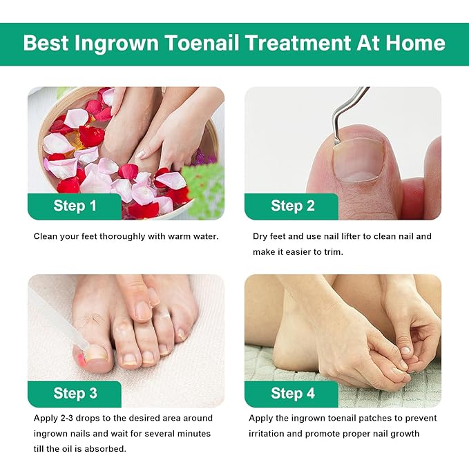 Ingrown Toenail Treatment - Ingrown Toenail Softener Drops,Toenail Lifter,Nail Patches,Best Ingrown Toenail Kit at Home for Easy Trim Thick Toe Nails Cleaner Tool Kit