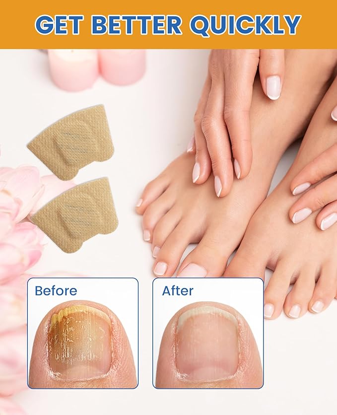 Nail TreatmentFungal Nail Patches For Toenails 32patches, Restore The Nails’ Natural Strength And Clarity.