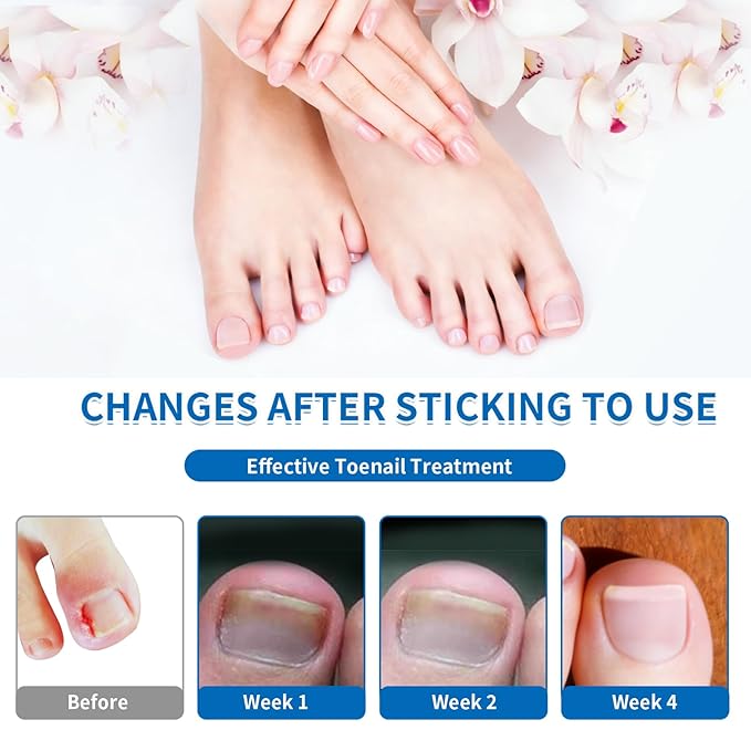 Ingrown Toenail Removal Kit - 50 Pcs Pain-Free Ingrown Toenail Corrector Strips with Toe Nail Lifter Painless File - Easy Use Ingrown Toenail Tools Kit