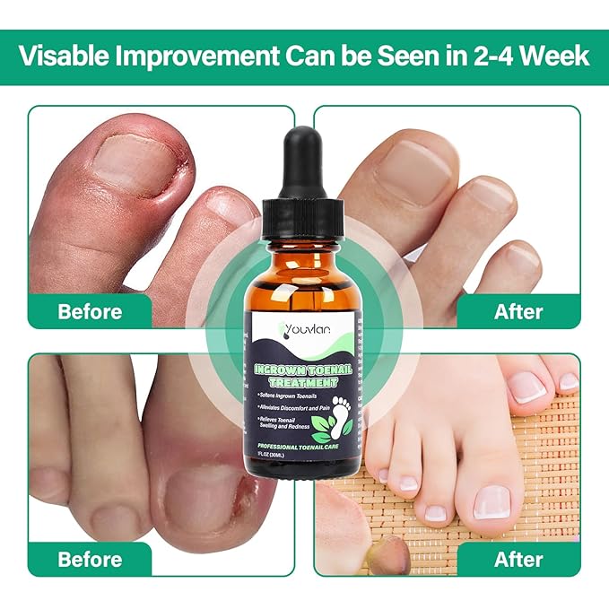 Ingrown Toenail Treatment Kit, Relieve Ingrown Toenail Pain, Repair Ingrown Toenail Issues, Safe and Convenient Home Solution