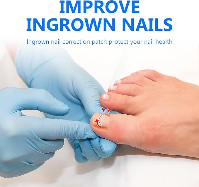 Ingrown Toenail Treatment, Toenail Correction Strips for Curved or Ingrown Nails, Quick Relief, Nail Correction, 5 Different Sizes
