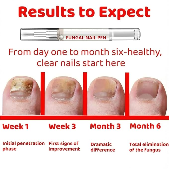 Allicin & Undecylenic Acid Fungal Nail Pen | Nail Repair Solution | Extra Strength Treatment Pen for Discolored Nails, 2 Pack