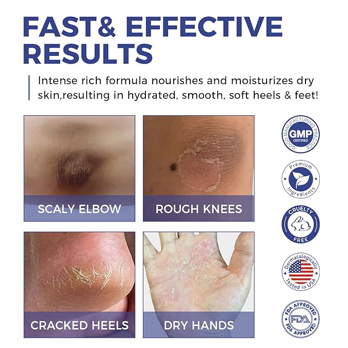 OUKEYA Urea Cream 42% Plus 2% Salicylic Acid – Intensive Foot & Hand Care for Very Dry, Cracked Skin, 5.29 oz (3 Pack)