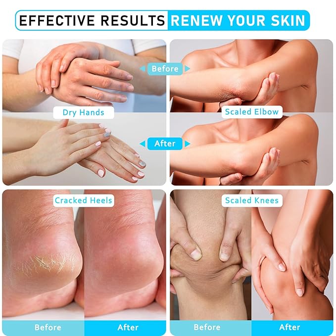 Urea 40% Foot Cream Maximum Strength - with Vitamin E & 2% Salicylic Acid - Deep Moisturizing for Winter Cracked Heels - Softens & Long Moisture for Rough Dead Skin on Hands, Feet, Elbows - Rich