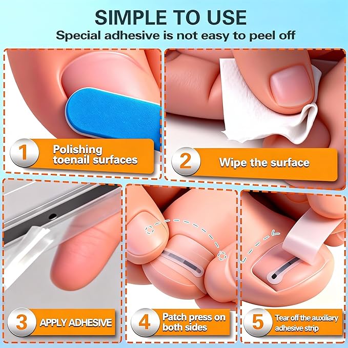 Titanium Alloy Ingrown Toenail Treatment - Professional Home Care for Curved Nails - Waterproof, Nail Tools and Ingrown Toenail Removal Kit,Ingrown Toenail Corrector(0.59/0.67in)