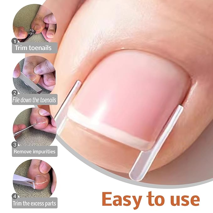 Ingrown Toenail Corrector Kit with Correction Strips, Breathable Ingrown Toenail Tape, Removal Kit for Ingrown Toenails in Women And Men